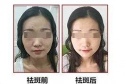 徒手祛斑爆料图片搞笑视频,搞笑视频带你领略祛斑新潮流